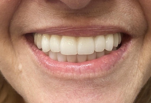 Person smiling with a full mouth of teeth
