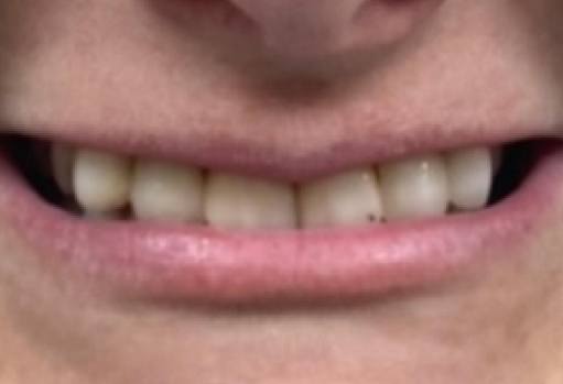 Close up of smile with slightly stained teeth
