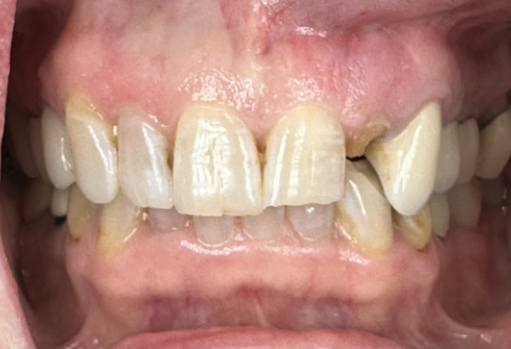 Close up of smile with slightly stained teeth