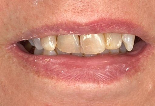 Close up of person smiling with discolored chipped teeth