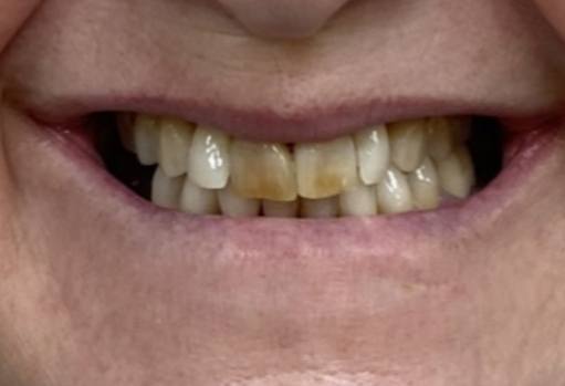 Close up of person smiling with stained teeth