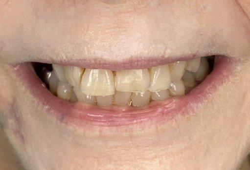 Close up of smile with slightly crooked and discolored teeth