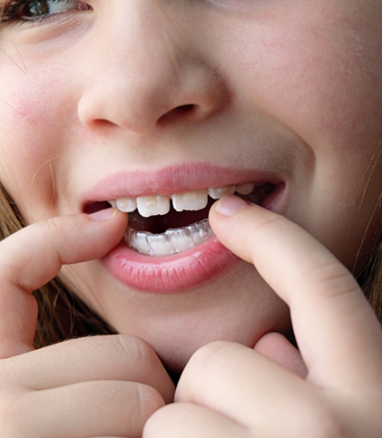 Patient with spaces between teeth putting in clear aligners