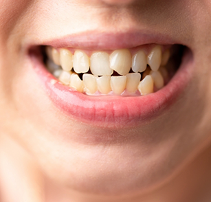 Close up of smile with crowded teeth
