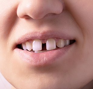 Close up of smile with gap between front teeth