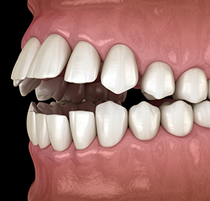 Illustration of an open bite