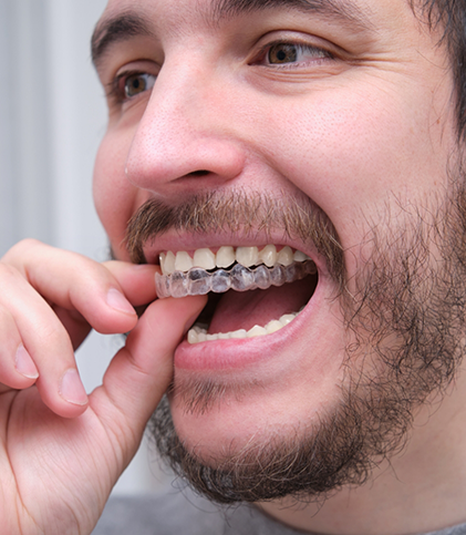 Man putting in a clear aligner
