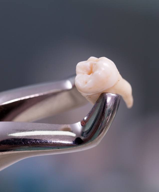 Dental forceps holding an extracted tooth