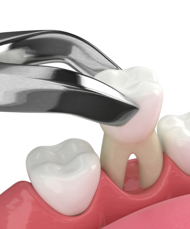 Illustrated dental instrument performing a tooth extraction in Cambridge