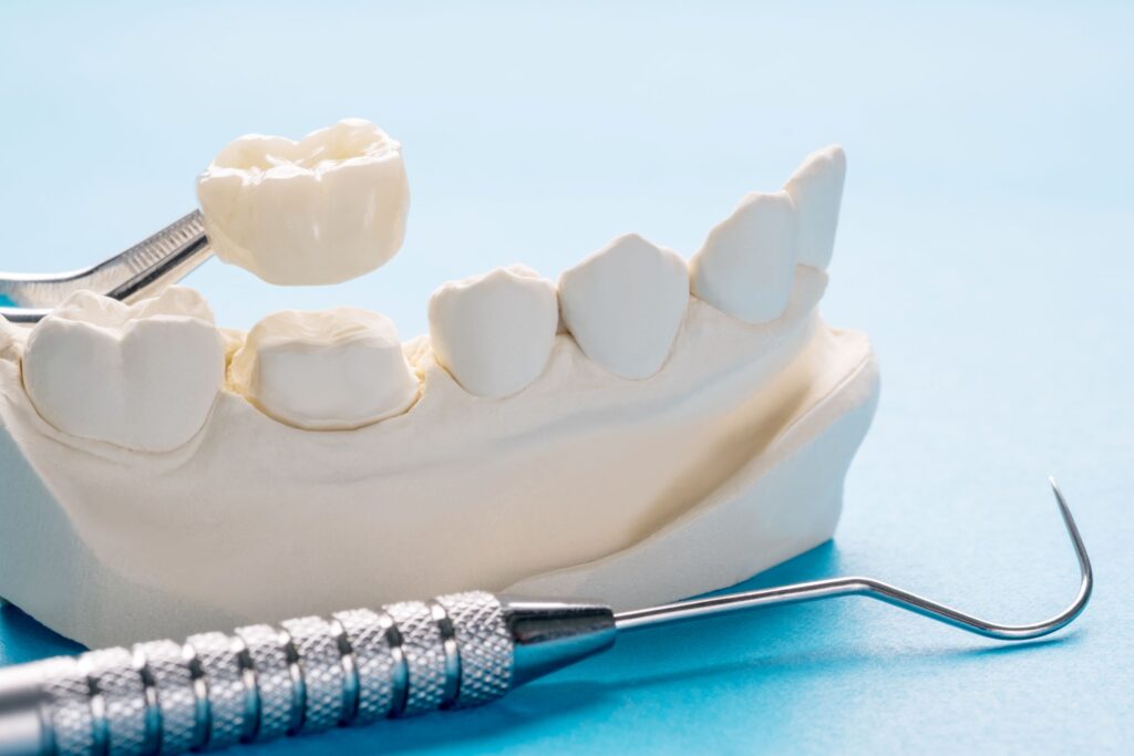 Dental crown over model jaw